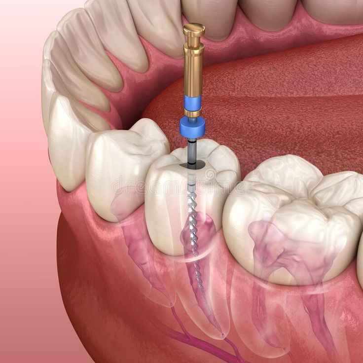 Endodoncia (Tratamiento de Canal)